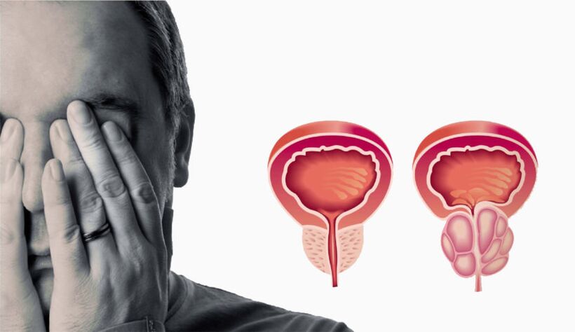 Prostatite crónica