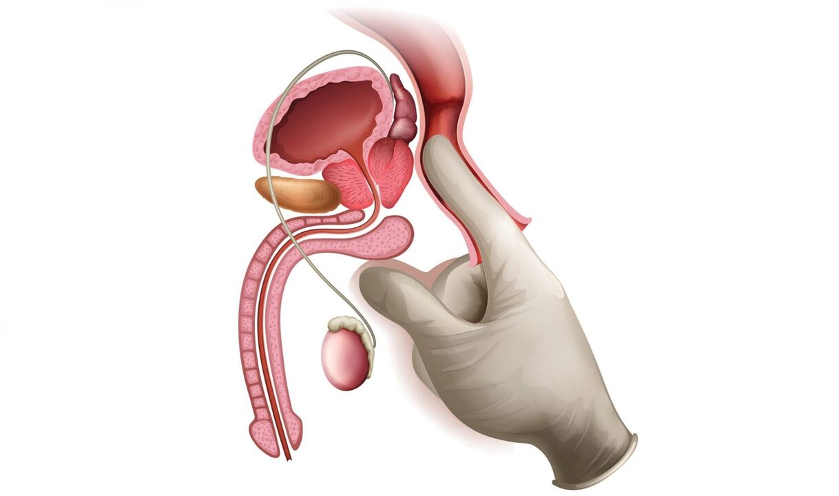 Masaxe prostática para prostatite