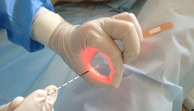 Tratamento con láser para prostatite
